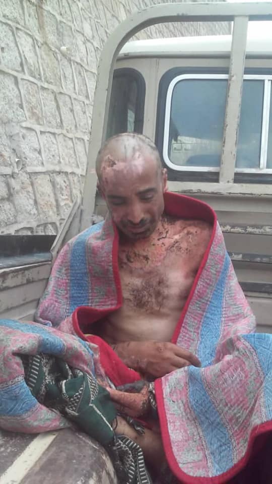 جريمة جديدة تهز الشارع اليمني.. الحوثيون يعذبون مختطفاً حرقاً ويرمونه في شارع بذمار