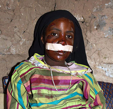 طفلة من فئة «المهمشين» في إب تتعرض لحادث والسائق يرميها بجوار عمارة وهي مضرجة بالدماء